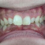 インビザライン治療　症例