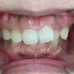 インビザライン治療GO　症例