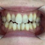 インビザライン治療GO 症例