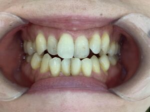 インビザライン治療GO　症例