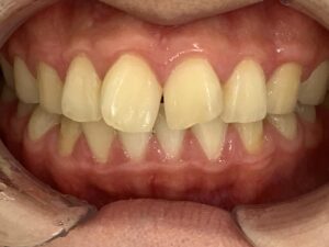 インビザライン治療GO　症例