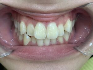 インビザライン治療GO　症例