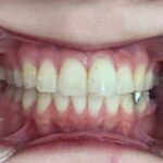 インビザライン治療GO 症例