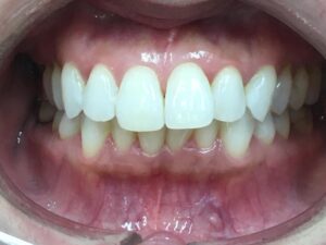 インビザライン治療GO　症例
