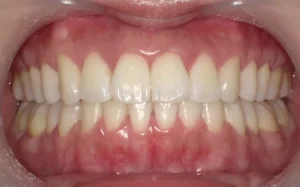 ホワイトニング　症例