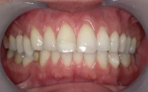 ホワイトニング　症例