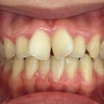 インビザライン治療 症例