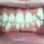 インビザライン治療　症例