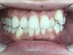 インビザライン治療　症例
