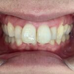 インビザライン治療　症例