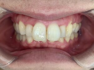 インビザライン治療　症例