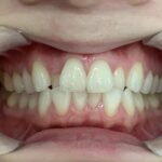 インビザライン治療 症例