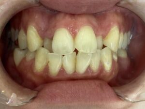 インビザライン治療　症例