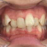 インビザラインGO治療 症例