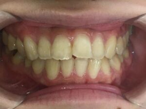 インビザライン治療　症例