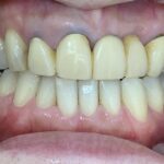 インビザラインGO治療 症例