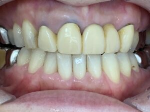 インビザラインＧO治療　症例