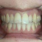 インビザラインGO治療 症例