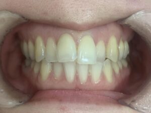 インビザラインＧO治療　症例