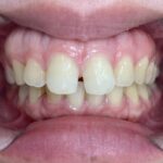インビザラインGO治療 症例