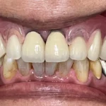 義歯　症例