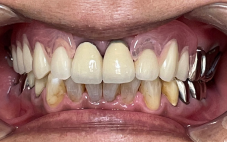 義歯　症例