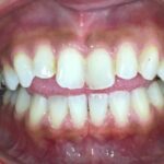 インビザライン治療 症例