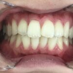 インビザライン治療 症例