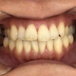 インビザライン治療　症例