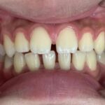 インビザライン治療 症例