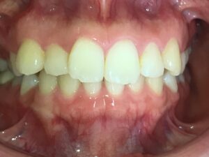 インビザラインＧO治療　症例