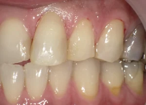 被せもの　症例