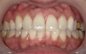 ホワイトニング　症例