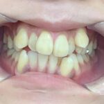 インビザライン治療 症例