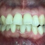 インビザライン治療　症例
