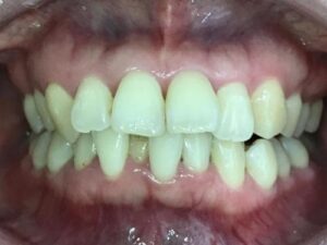 インビザライン治療　症例
