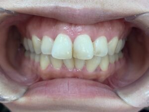 インビザラインＧO治療　症例