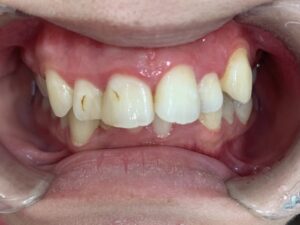 インビザラインＧO治療　症例