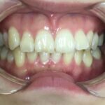 インビザライン治療　症例