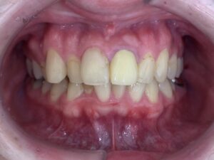 インビザラインＧO治療　症例