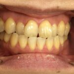 インビザライン治療　症例