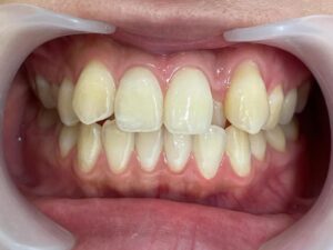 インビザライン治療　症例