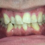 インビザライン治療　症例
