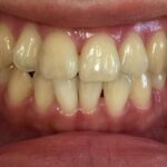 インビザライン治療　症例