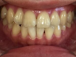 インビザライン治療　症例