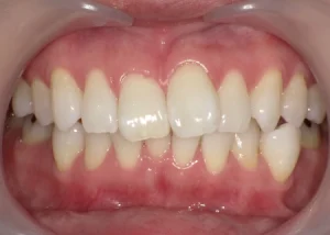 ホワイトニング　症例